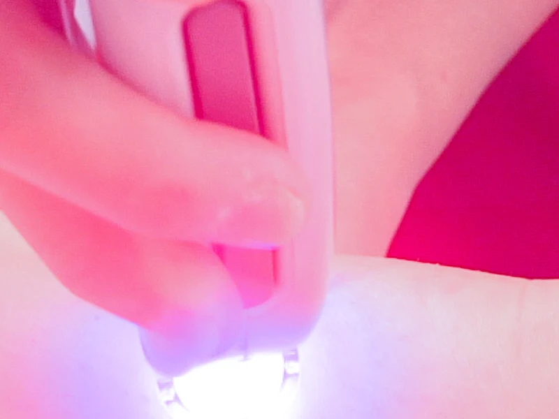 Laser Hair Reduction treatment at Radiant Glow Pune